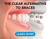 AlignerSmlCrp